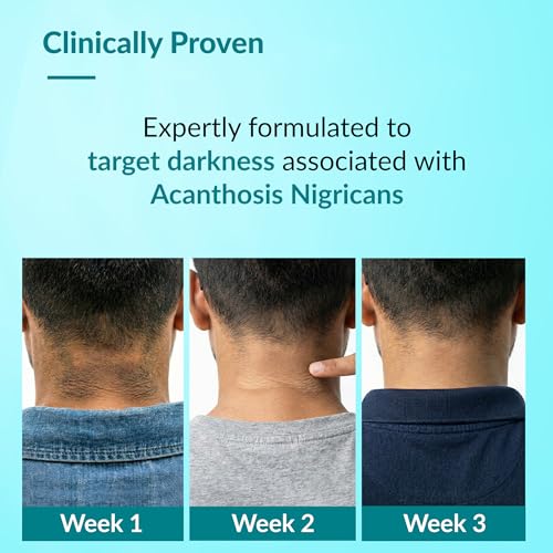 Image of Fixderma Nigrifix Advance Cream for Acanthosis Nigricans with Melatonin, Retinol & Lactic Acid | For Dark Body Parts like Neck, Ankles, Knuckles, Armpits, Thighs & Elbows | Dermatologist Tested - 50g