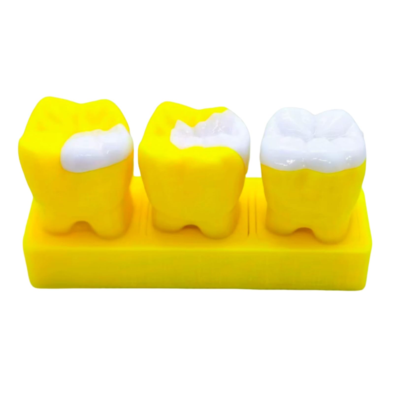 YRQMGSF 6X Teeth Model Inlay Display Model,Dental Teeth Care Model,Dentistry, High Inlays, Gifts for Dentists,Yellow