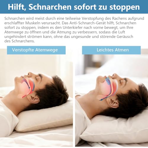 Schnarchstopper Anti Schnarch: schnarchschiene schnarchen stopper - anti schnarch schiene Gegen Schnarch Snore schnarchfrei-pro - blue - C Size