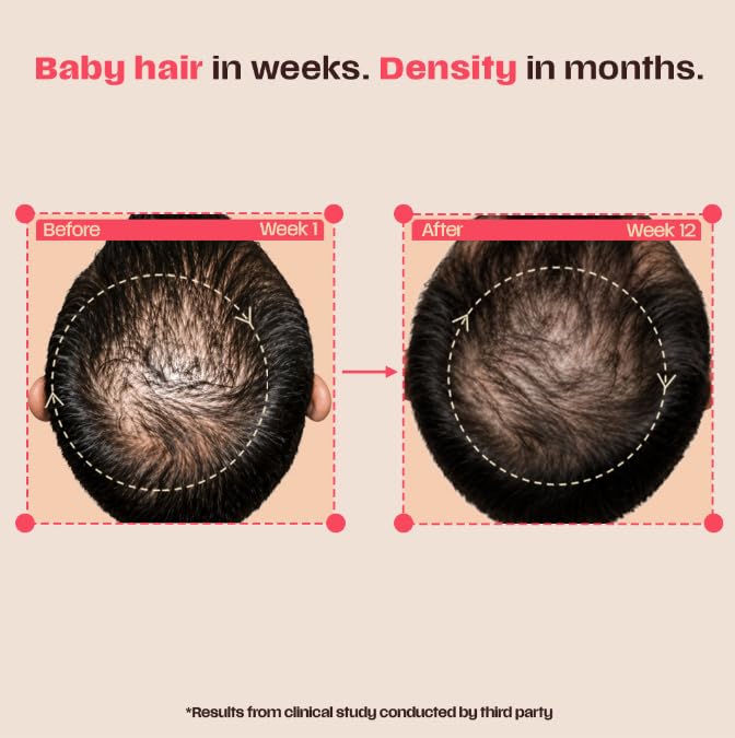 Image of Days Ahead Leave-In Hair Growth Serum | Redensyl, Anagain, Caffeine & Ceramide | Promotes New Hair Growth | Advanced Anti Hair Fall Treatment | Non-Sticky, Oil-Control Formula |For Both Women & Men