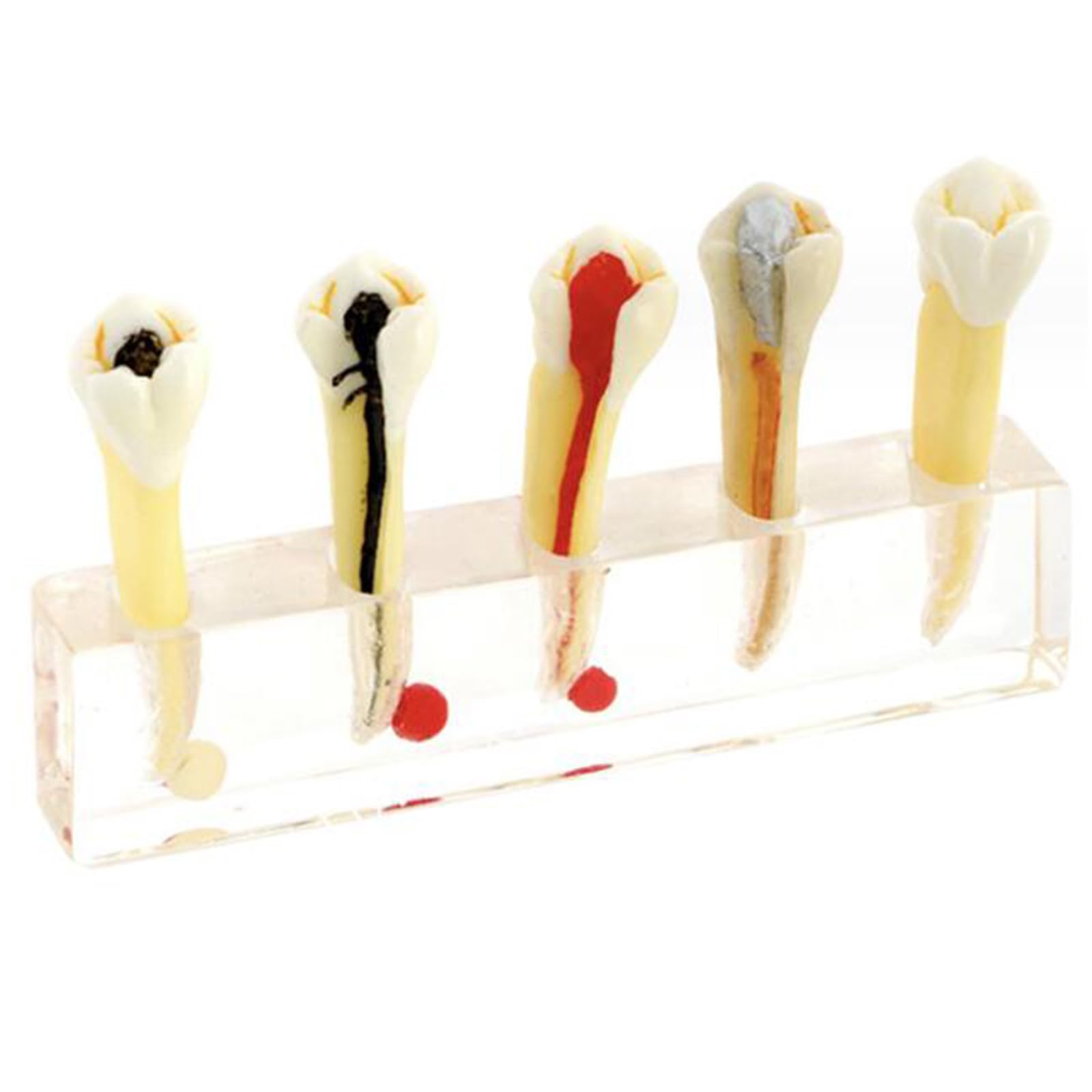 Modèle de traitement du canal radiculaire, modèle dentaire de canal radiculaire endodontique, modèle de formation à l'examen médical pour l'étude et l'enseignement