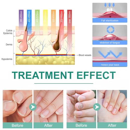 BHCASE Dispositivo de terapia de luz para fungos nas unhas, lua do sul, lâmpada para tratamento de f