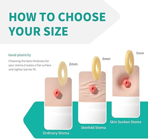 Miniatura 3 de 20 anillos de barrera para ostomía, anillos moldeables de ostomía de 0.157 in de grosor, anillos extensores hidrocoloides para bolsas de colostomía