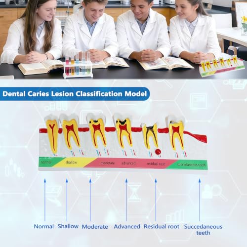 Image of Dental Caries Progression Model,6-Stage Tooth Decay Classification Model for Dental Education,Dental Training,Demonstrations,Oral Care Educatio