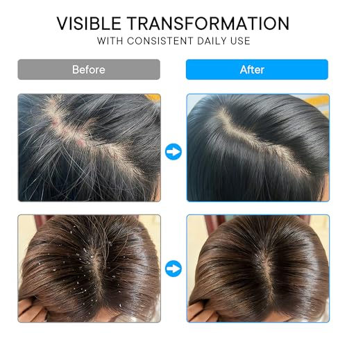 Image of ProBliva Psoriasis Scalp Spray: Scalp Treatment for Psoriasis, Dandruff & Seborrheic Dermatitis - On-Demand Itch Relief - Helps Relieve Flaking, Scaling & Dryness - Lightweight & Non-Greasy - 2 Pack