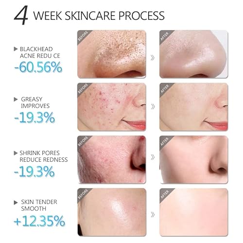 Salicylic Acid Face Mask Anti Acne Blackhead Facial Masks Oil Control Shrink Pores Skin Care Beauty Health #TOP5