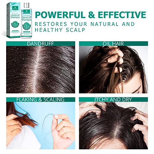 Roycederm Anti-Dandruff Shampoo, Ketoconazole Shampoo, Dandruff Treatmen For Oily Hair, Dry Flakey Scalp Treatment, Dry Scalp Shampoo, Scalp Treatment For Dry Itchy Oily Scalp, Fast Relief #TOP3