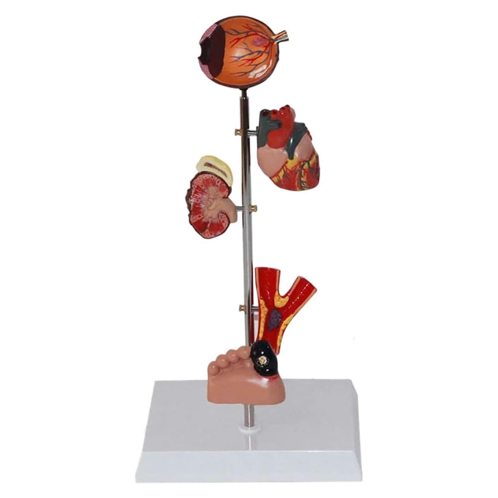 Modèle De Diabète Médical, Modèle D'organe du Diabète, Modèle Anatomique D'organe Diabétique Pathologique, Modèle D'organe 5 Parties pour Les Médecins