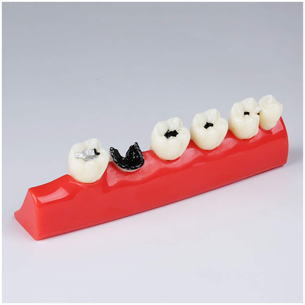 sjdoPulse Dental Teeth Caries Developing Model - Dental Teeth Study Teaching Model - Simulation Oral Tooth Teeth Model for Education Teeth Demonstration Model (A)