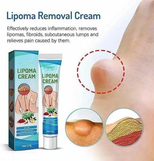 Buy ZYZHT 20g Lipoma Removal Cream: Gentle, User-Friendly Care