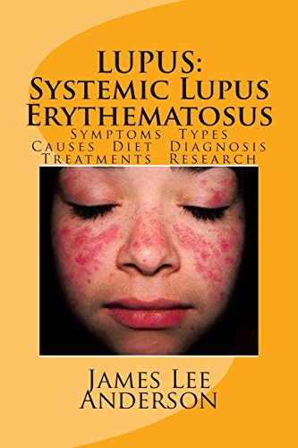 Lupus Systemic Lupus Erythematosus: Symptoms. Types. Causes. Diet. Diagnosis. Treatments. Research.