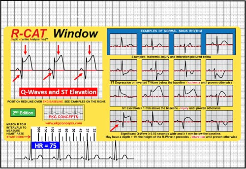 Fenêtre R-Cat EKG 2e édition solution lecture ECG sans erreur de tracé