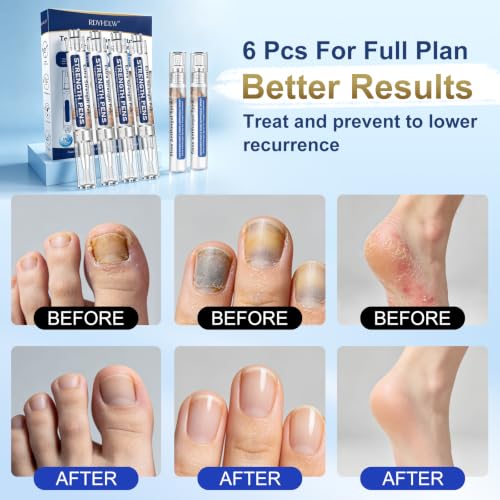 Image of Toenail Fungi Treatment Extra Strength - Fungi Nail Pen