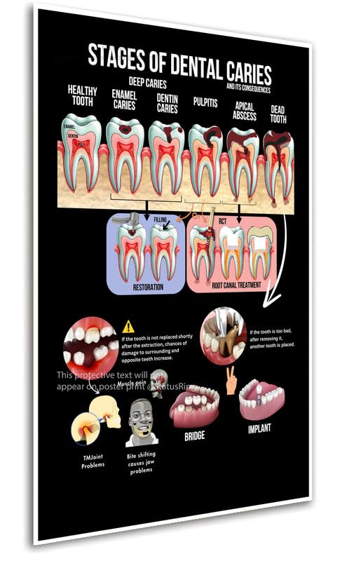 Dental caries Stages Consequences BK Dental Clinic Poster without Frame