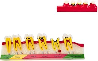 SNAWOP Periodontal Disease Model Dental Caries Developing Teeth Model for Dentist and Patients Communication and Tooth Typodont Study Teaching and Education