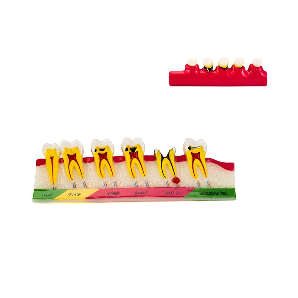 SNAWOP Periodontal Disease Model Dental Caries Developing Teeth Model for Dentist and Patients Communication and Tooth Typodont Study Teaching and Education