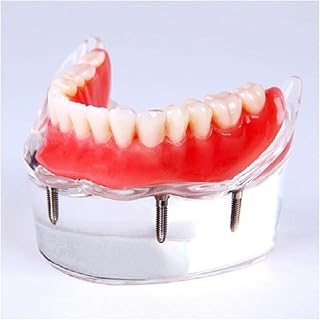 ZMX Implant Teeth Model - Educational Model Implant Nail Denture Restoration Tooth Model - Tooth Model for Dentistry Teaching - for Study Teaching Display