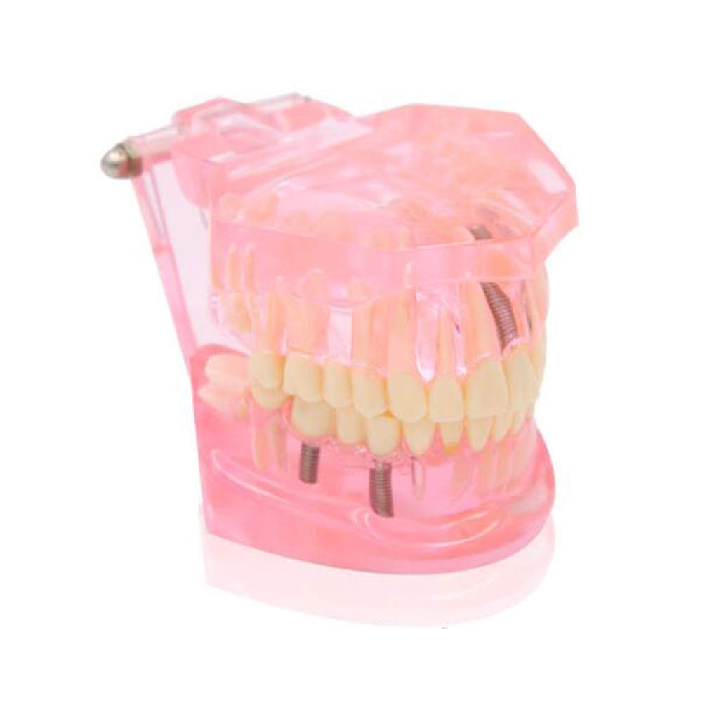 Modello Anatomico dei Denti - Modello di Dente per Addestramento alle Operazioni Ortodontiche Staccabili Trasparenti - per Aiuti allo Studio Educativo Medico, Attrezzature da Laboratorio