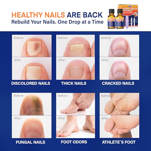 image for VigorWell Toenail Fungus Treatment with 25% Undecylenic Acid: Toenail 