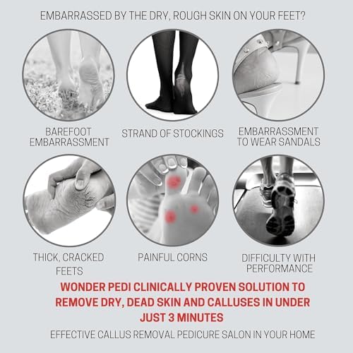 Image of Callus Remover - Three Minutes Fix- Foot File Rasp - Instant Foot Exfoliating Softener Peel Spray, Heels Callus Scrubber File - Home Spa Pedicure Treatment. Wonder Pedi