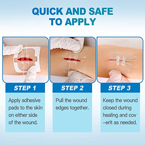 Senvok Butterfly Bandaids For Wound Closure, 2 Pcs Zip Stitch Wound Closure Strips, Surgical Laceration Repair Without Sew - Quick Clot - Emergency Wound Closures Device (Pu) #TOP2