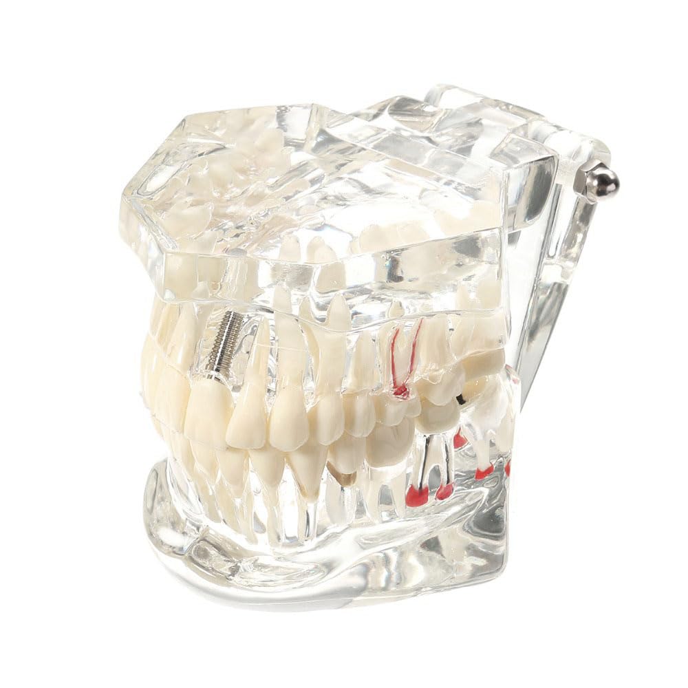Modèle Dent, Modèle Dentaire Pédagogique Transparent Amovible, Implant Dentaire Modèle, Modèle Médical d'Enseignement, Modèles et Matériel Dentaire Éducatif pour Étude de la Maladie
