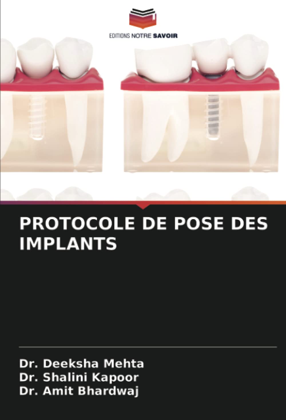 PROTOCOLE DE POSE DES IMPLANTS