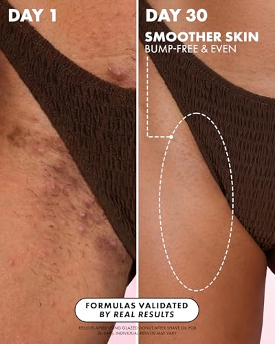 The Best Dark Spot Remover for Bikini Area: A Complete Guide to Even Skin Tone 12 Truly Beauty Glazed Donut After Shave Oil - Razor Bumps Treatment for Women, Razor Bump and Ingrown Hair Treatment for Bikini Area - 3.1 OZ