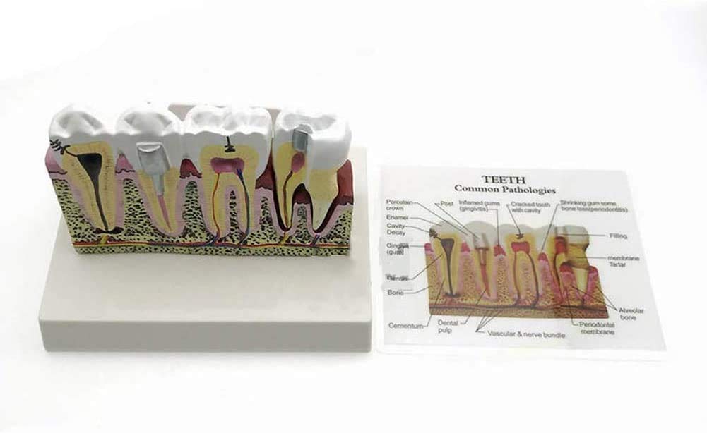 Modelo De Enfermedad Modelo Anatómico De Implantes Dentales De Atención Dental, Dientes Removibles, para Presentaciones Médicas Y Formación En Higiene
