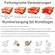 LMNOOP® Wundliegen-Creme, Wundheilungssalbe Hautreparaturbehandlung Infektionsschutz Erste-Hilfe-Salbe für Dekubitus & Druckgeschwüre Diabetische Venenfuß- und Beingeschwür Verbrennungen Schnitte
