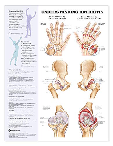 Image of Understanding Arthritis Anatomical Chart