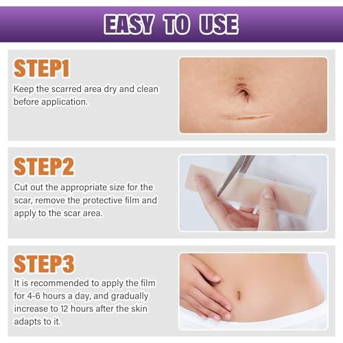Image of Medical Grade Silicone Scar Tape Scar Sheet,Scar Strips,Scar Remover,C-Section, Surgery, Keloid, Tummy Tuck, Scar Patch (1.6 inchX 60 inch 4cmx1.5m)