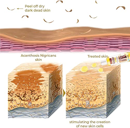2pezzi GFOUK Acanthosis Nigricans Olio