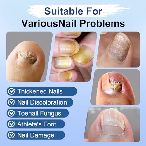 Image of Toenail Fungus Treatment Extra Strength, Fungi Nail Pen, 25% Undecylenic Acid, Ingrown toenail treatment, Repairs Yellow Thick Brittle Toe and foot fungus treatment extra strength - 9Pcs
