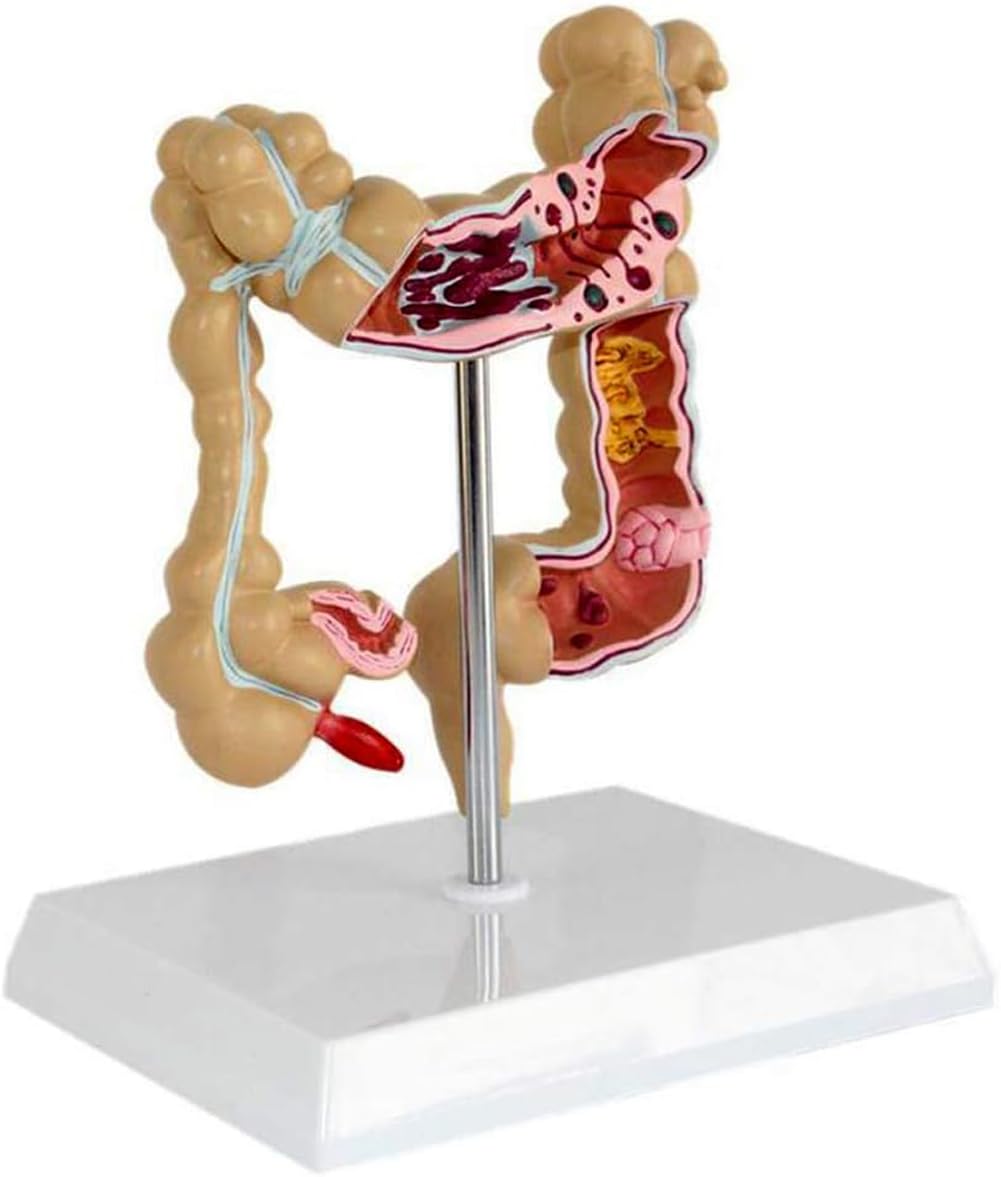 Model patologicznej zmiany jelita grubego człowieka, naturalnie duże narzędzie do nauczania anatomii do edukacji medycznej i treningu klinicznego