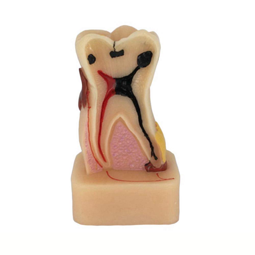 Sjdopulse B Dental Care Model - Teeth Anatomical Model - Comprehensive Pathology Tooth Model - Resin Material Dental Teeth Model - For Study Display Teaching Medical Model (B)