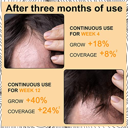 5% Minoxidil Foam For Men & Women Hair Regrowth Treatment, Keeps Hair Regrowth, Stop Hair Loss And Thinning, Helps Hair Growth, Promotes Hair Follicle Growth, Mild Non-Irritating Formula, 2.11Fl Oz #TOP2