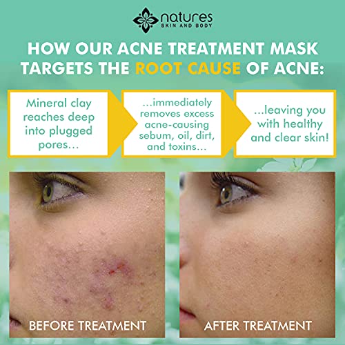 Natural Clear Acne Treatment Facial Mask – Works Better Than Benzoyl Peroxide And Salicylic Acid To Clear Acne Spots, Zits, Blemishes And Remove Blackheads And Gunk From Deep In The Pores-All Natural #TOP1