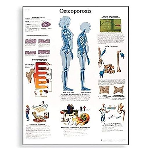 3B Scientific Osteoporosis guía de posición de