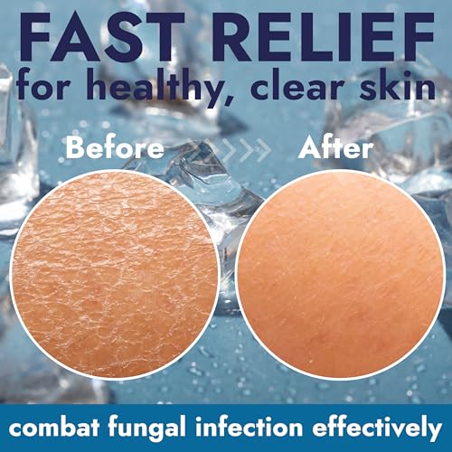 Image of Antifungal Soap Infused with Peppermint Essential Oil for Itchy Skin