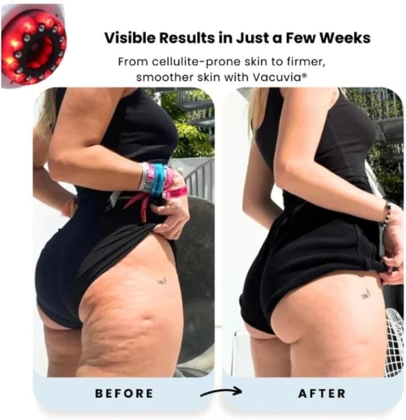 Vacuvia SculptGlow Appareil Anti Cellulite