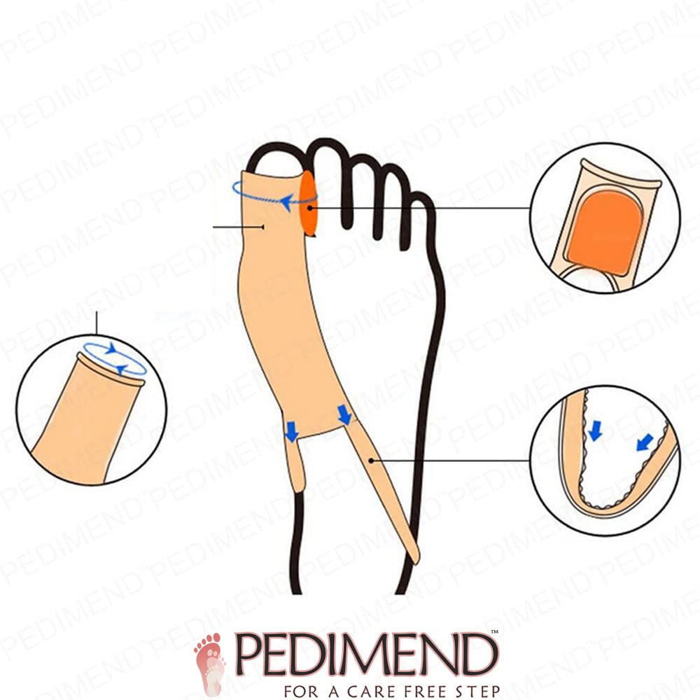 4 Pieces Hallux Valgus Correction by Pedimend - Orthotics Big Toe Straightener Belt - Silicone Gel Bunion Splint - Smoothing Bent Toes - Big Foot Alignment - UNISEX - Foot Care