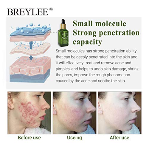 Sunlucky Scar Removal Serum - Scar Treatment For Face And Body - 17 Ml Hydrating Oil For Acne Scar Remover, Stretch Mark Removal, And To Lighten Dark Spots (Green) #TOP5