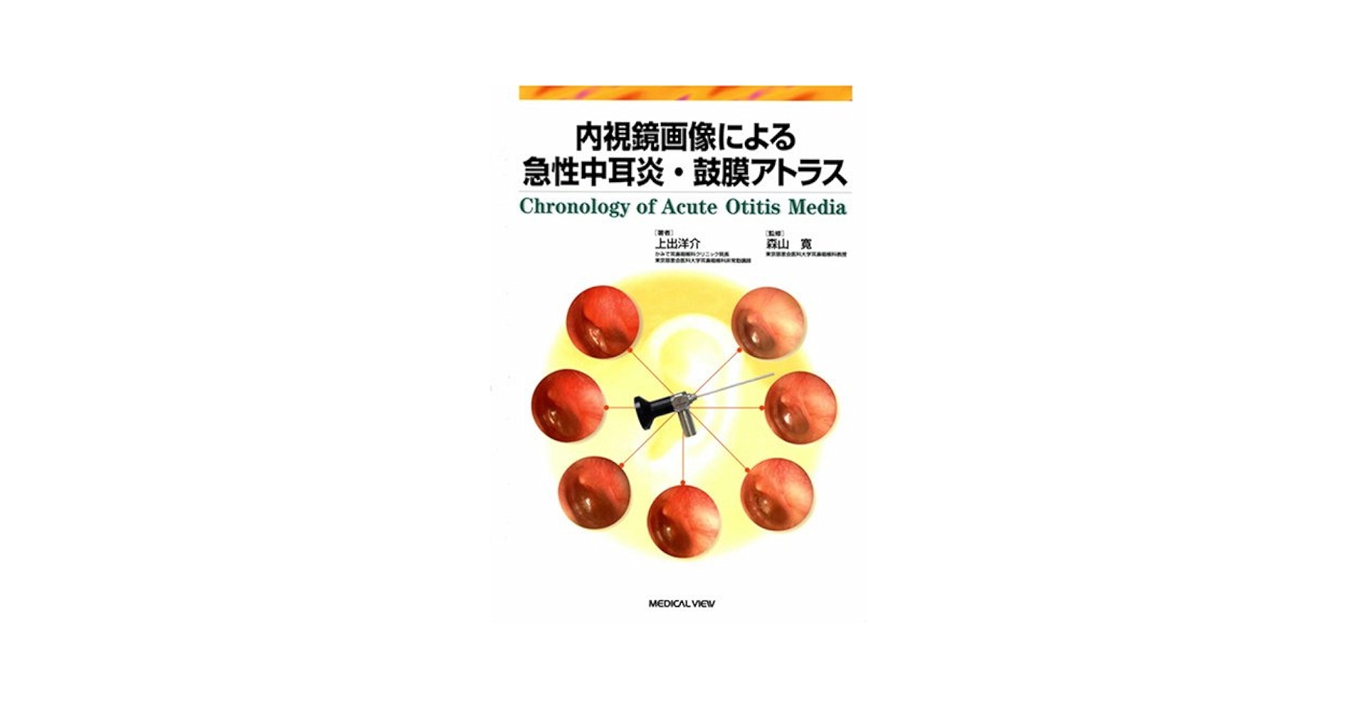 内視鏡画像による急性中耳炎・鼓膜アトラス 内視鏡画像による急性中耳炎・鼓膜アトラス | 上出 洋介 |本