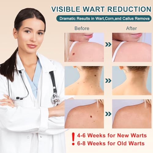 Image of Skin Tag Remover,Wart Remover Freeze Off Liquid with 17% Salicylic Acid - Fast-Acting Freeze Off Treatment for Common & Plantar Warts,Flat Wart, Corns - for Feet, Hands & Body 1Ounce