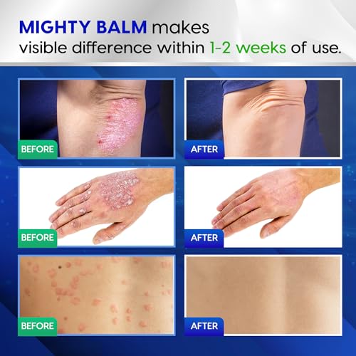 Tobcharm Antifungal Cream, Antifungal Cream for Skin, Ringworm Treatment for Humans, Jock Itch Cream, Eczema, Athletes Foot Cream, Tea Tree Oil for Skin 1oz