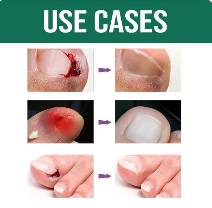 Nozti Anti Paronychia Relief Oil, 10ml, Natural Nail Treatment for Pain Relief and Disinfection - Image 5 thumbnail