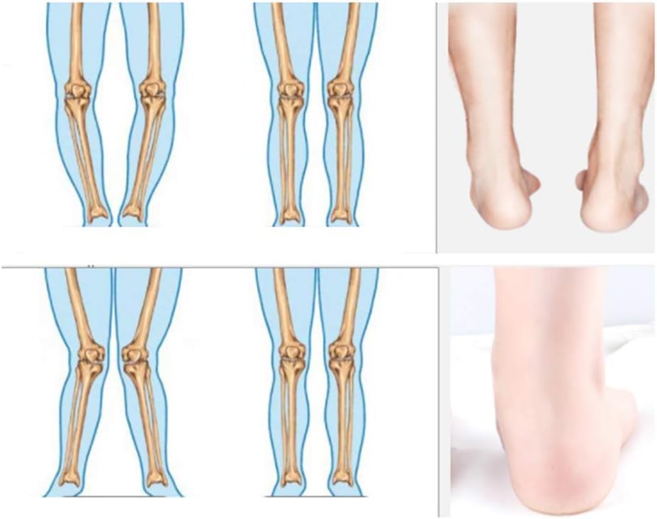 Solette Plantari Gambe Tipo X/o Inserti Ortopedici per Piedi Piatti, Fascite Plantare, Sperone Osseo, Sostegno, 43~44