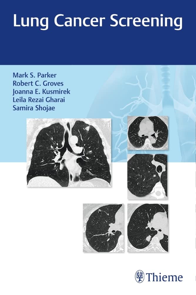 Buy Lung Cancer Screening — BookShops.in