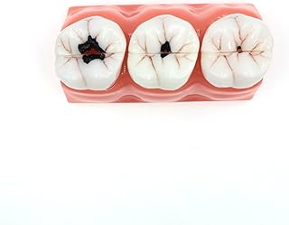 Fuioda 4Times Dental Caries Removable Teeth Tooth Model Decomposition Dissected Teeth Model Teaching Research Study Model